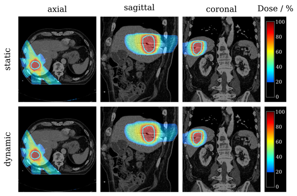Rekonstruierte 4D Dosisverteilung der Behandlung eines Leberkarzinoms